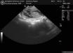 Ultrasound